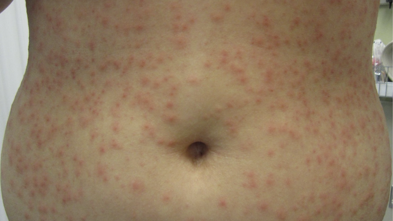 How to avoid spa pool folliculitis (pseudomonas folliculitis)