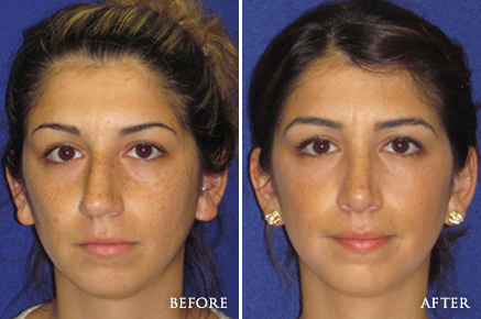 Before and After