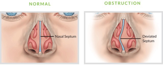nose diagram with deviated septum