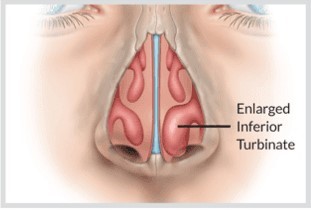 enlarged inferior turbinate diagram