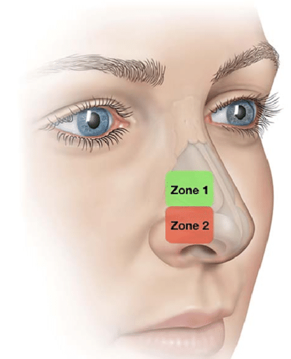 zone 1 and 2 of the nose