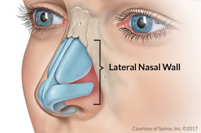 example of lateral nasal wall