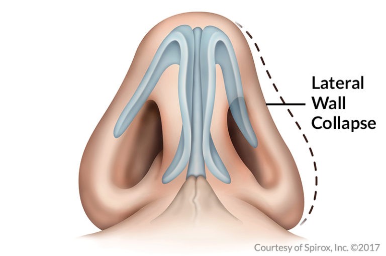 example of wall collapsing nasal valve