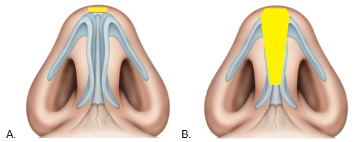 before and after example of cartilage grafting