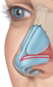 Lower Lateral Cartilage