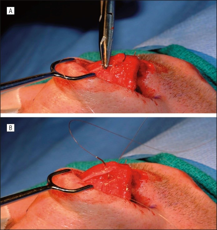 Suture Shaping Example