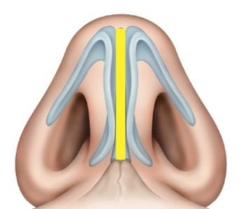 Droopy Ptotic Tip