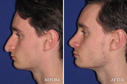 Before and After