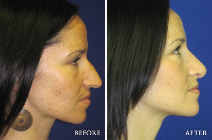 Before and After Rhinoplasty