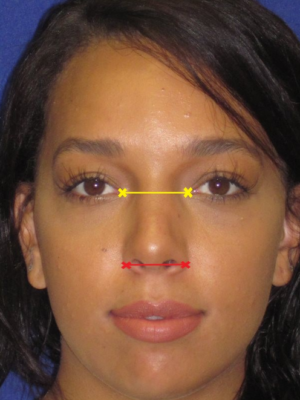 before rhinoplasty demonstration