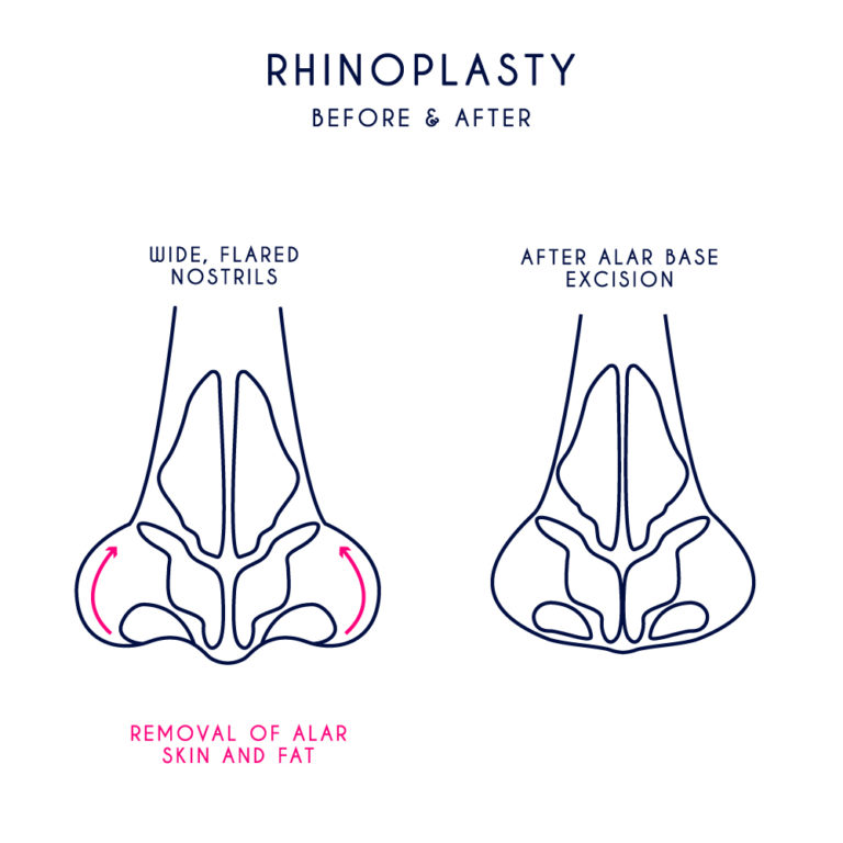 Before and after Rhinoplasty example