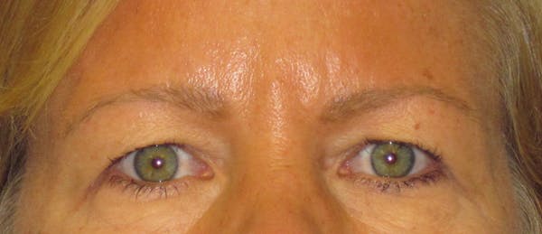 Blepharoplasty Before & After Gallery - Patient 4882943 - Image 1