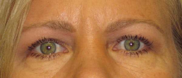 Blepharoplasty Before & After Gallery - Patient 4882943 - Image 2