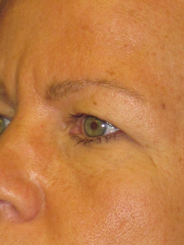 Blepharoplasty Before & After Gallery - Patient 4882943 - Image 3