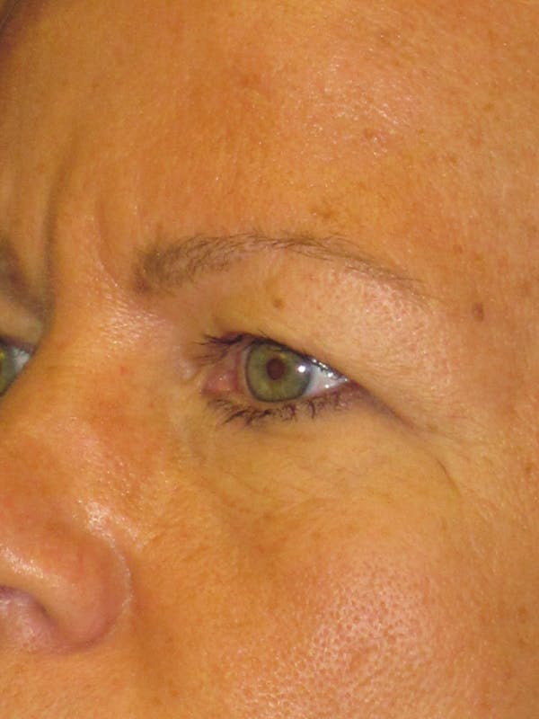 Blepharoplasty Before & After Gallery - Patient 4882943 - Image 3