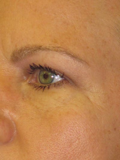 Blepharoplasty Before & After Gallery - Patient 4882943 - Image 4