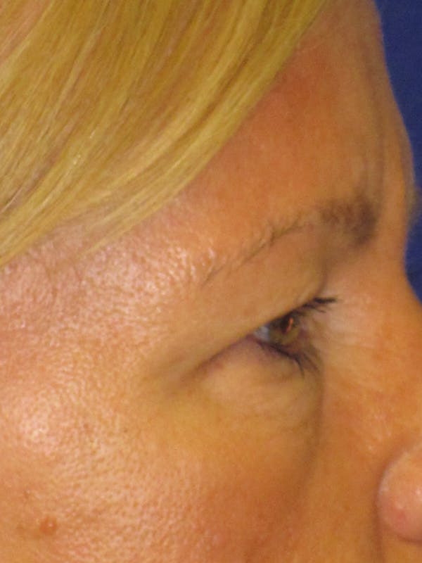 Blepharoplasty Before & After Gallery - Patient 4882943 - Image 5