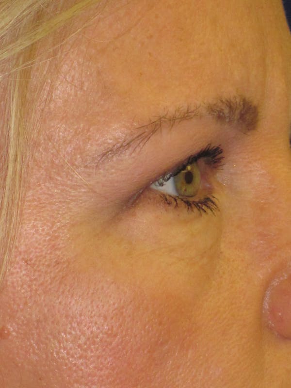 Blepharoplasty Before & After Gallery - Patient 4882943 - Image 6