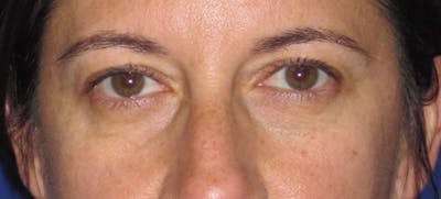 Blepharoplasty Before & After Gallery - Patient 4883043 - Image 1