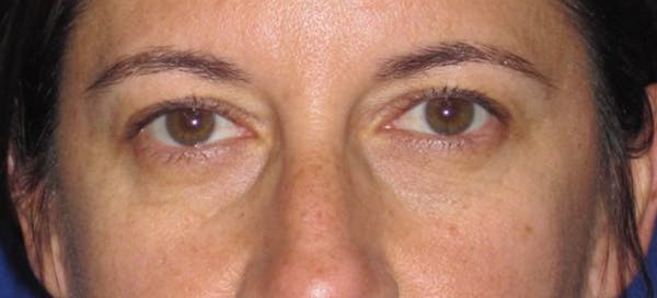 Blepharoplasty Before & After Gallery - Patient 4883043 - Image 1