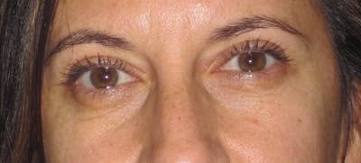 Blepharoplasty Before & After Gallery - Patient 4883043 - Image 2
