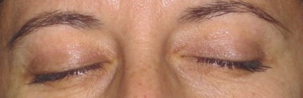 Blepharoplasty Before & After Gallery - Patient 4883043 - Image 3