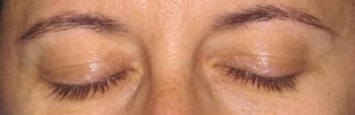 Blepharoplasty Before & After Gallery - Patient 4883043 - Image 4