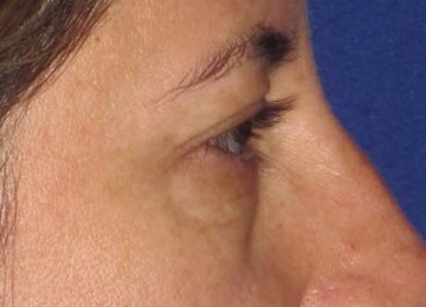 Blepharoplasty Before & After Gallery - Patient 4883043 - Image 5
