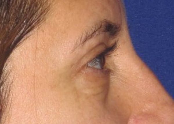 Blepharoplasty Before & After Gallery - Patient 4883043 - Image 6