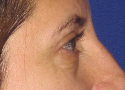Blepharoplasty Before & After Gallery - Patient 4883043 - Image 6