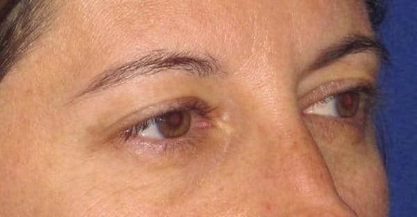 Blepharoplasty Before & After Gallery - Patient 4883043 - Image 7