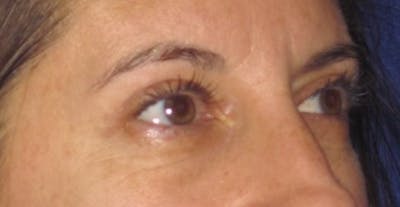 Blepharoplasty Before & After Gallery - Patient 4883043 - Image 8
