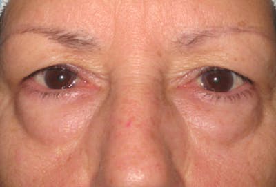Blepharoplasty Before & After Gallery - Patient 4883044 - Image 1