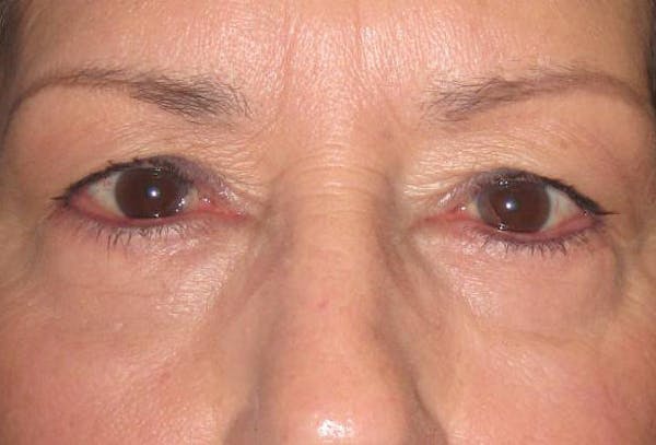 Blepharoplasty Before & After Gallery - Patient 4883044 - Image 2