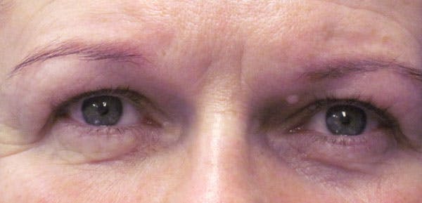 Blepharoplasty Before & After Gallery - Patient 4883045 - Image 1