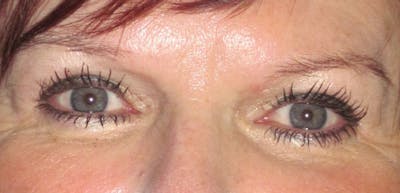 Blepharoplasty Before & After Gallery - Patient 4883045 - Image 2