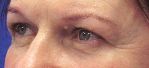 Blepharoplasty Before & After Gallery - Patient 4883045 - Image 3