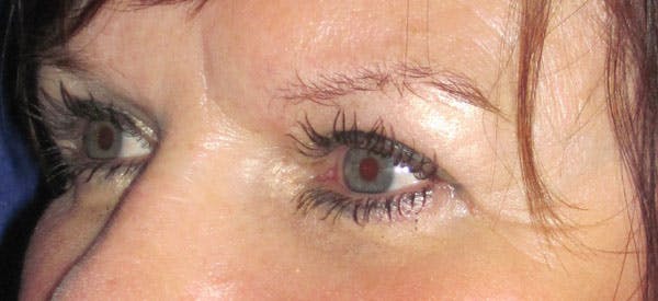 Blepharoplasty Before & After Gallery - Patient 4883045 - Image 4
