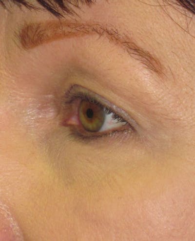 Blepharoplasty Before & After Gallery - Patient 4883046 - Image 1