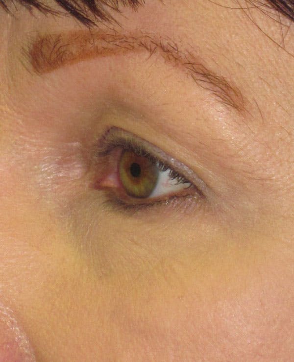 Blepharoplasty Before & After Gallery - Patient 4883046 - Image 1