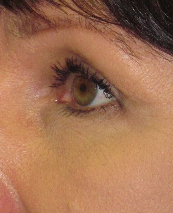 Blepharoplasty Before & After Gallery - Patient 4883046 - Image 2
