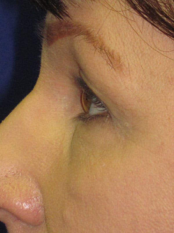 Blepharoplasty Before & After Gallery - Patient 4883046 - Image 3