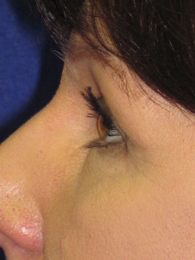 Blepharoplasty Before & After Gallery - Patient 4883046 - Image 4