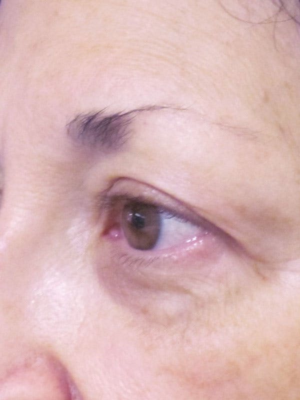 Blepharoplasty Before & After Gallery - Patient 4883051 - Image 1