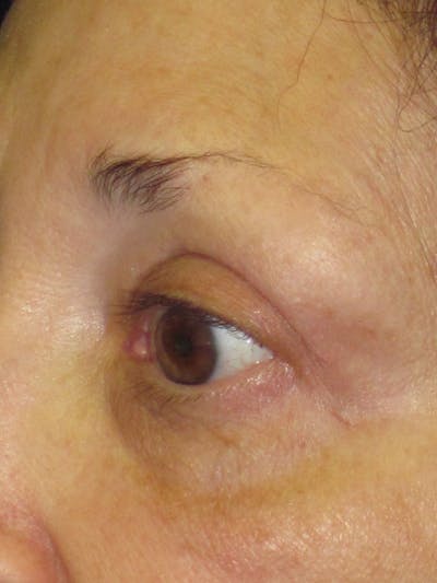 Blepharoplasty Before & After Gallery - Patient 4883051 - Image 2