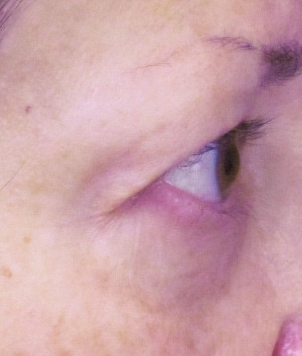 Blepharoplasty Before & After Gallery - Patient 4883051 - Image 3