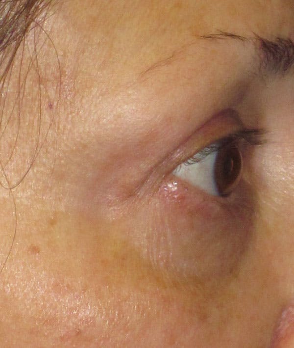 Blepharoplasty Before & After Gallery - Patient 4883051 - Image 4