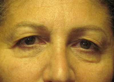 Blepharoplasty Before & After Gallery - Patient 4883053 - Image 1