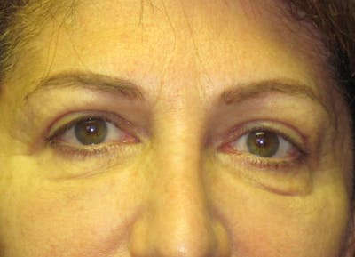 Blepharoplasty Before & After Gallery - Patient 4883053 - Image 2