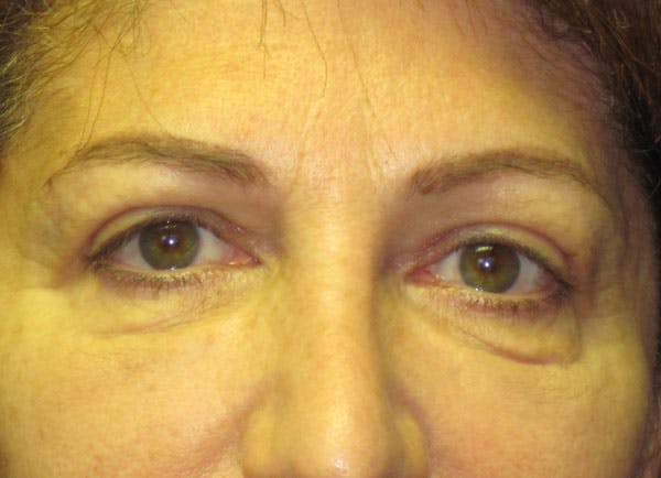 Blepharoplasty Before & After Gallery - Patient 4883053 - Image 2